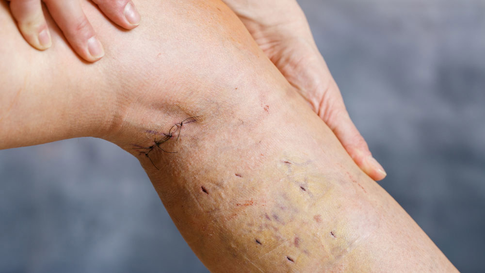 Buried Sutures Are Left Untreated