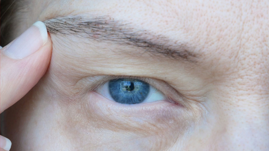 Middle-Aged Eyelid Surgery